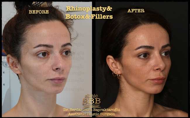 rhinoplasty before after 7