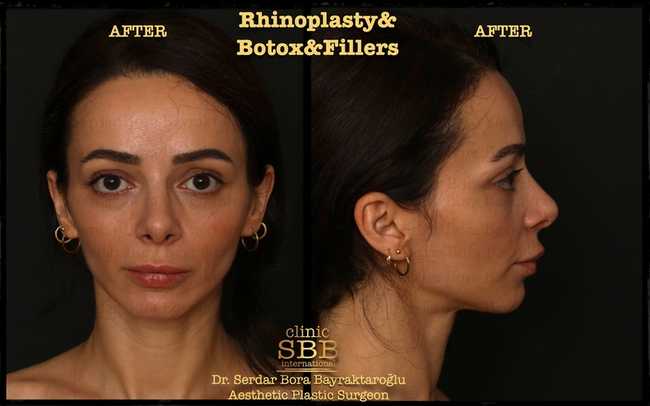rhinoplasty before after 9