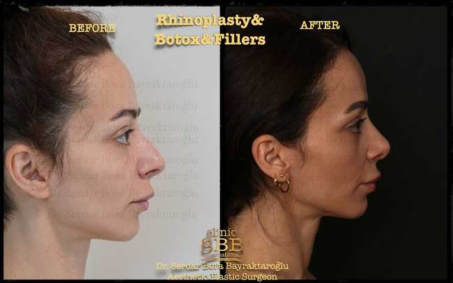 rhinoplasty before after 8