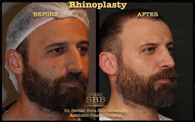 rhinoplasty before after 12