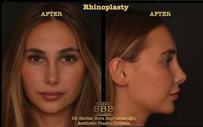 rhinoplasty before after 4