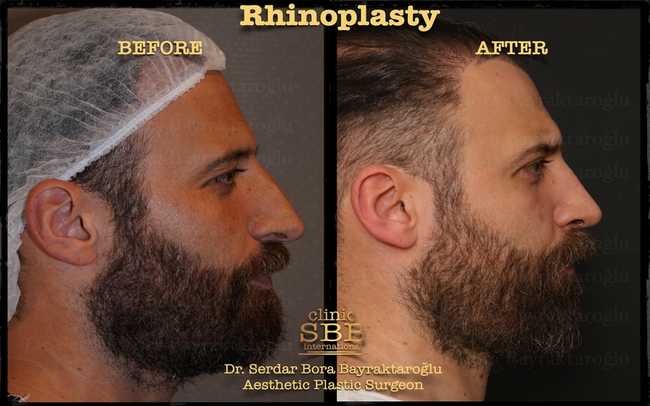 rhinoplasty before after 13