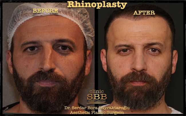 rhinoplasty before after 11