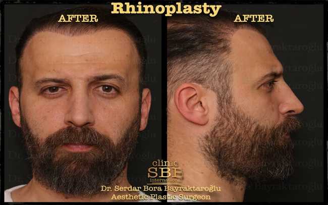 rhinoplasty before after 14