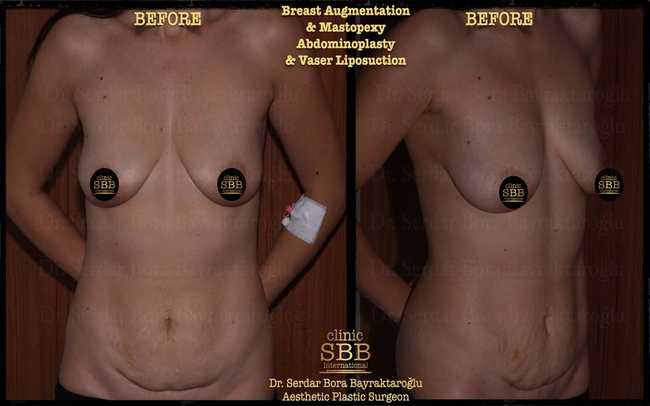 vaser liposuction before after 6