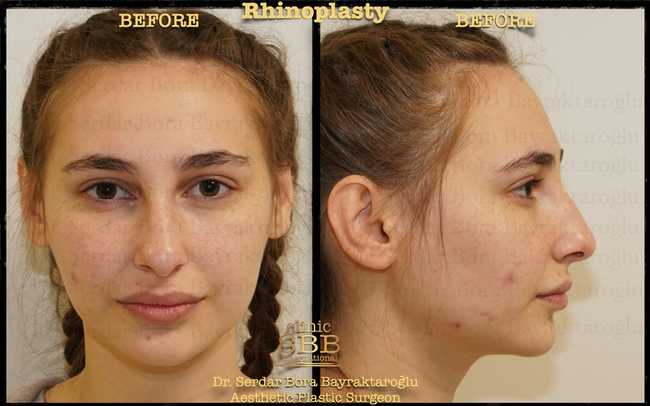rhinoplasty before after 1