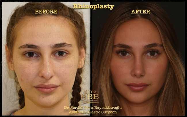 rhinoplasty before after 2