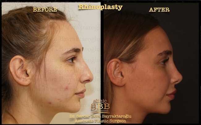 rhinoplasty before after 3