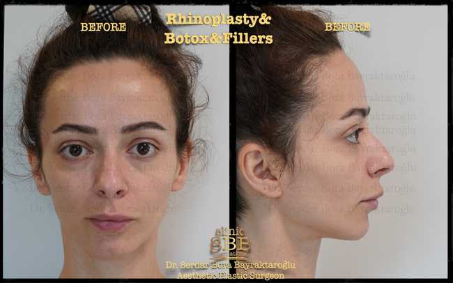 rhinoplasty before after 5