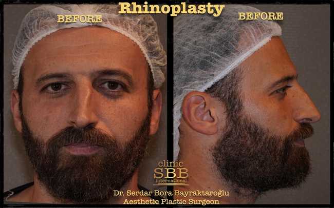 rhinoplasty before after 10